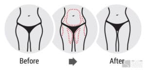 Skin Removal After Weight Loss
