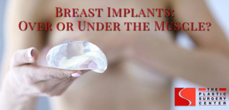 Under Muscle Breast Implant Surgery vs Over