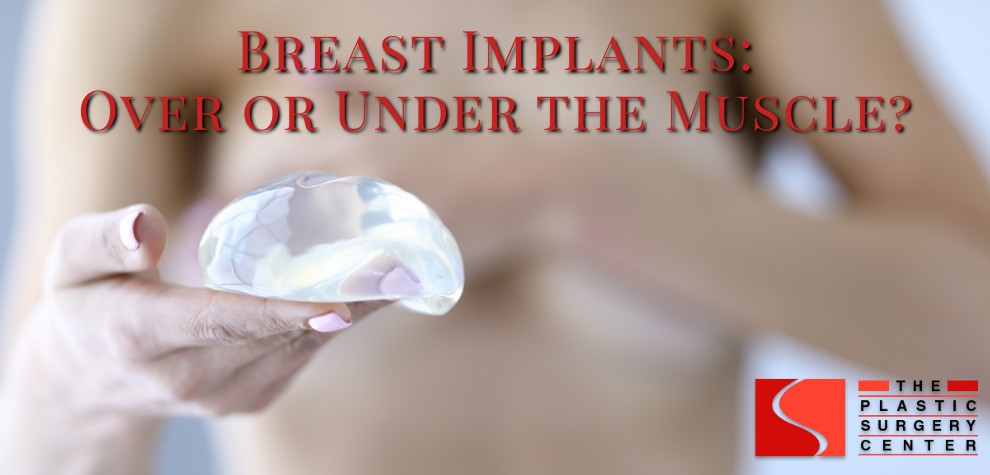 Over or under the muscle breast implants