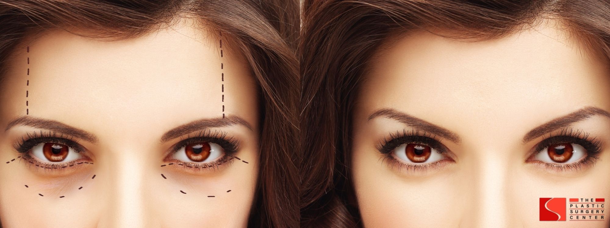 eyebrow lift surgery shreveport and monroe