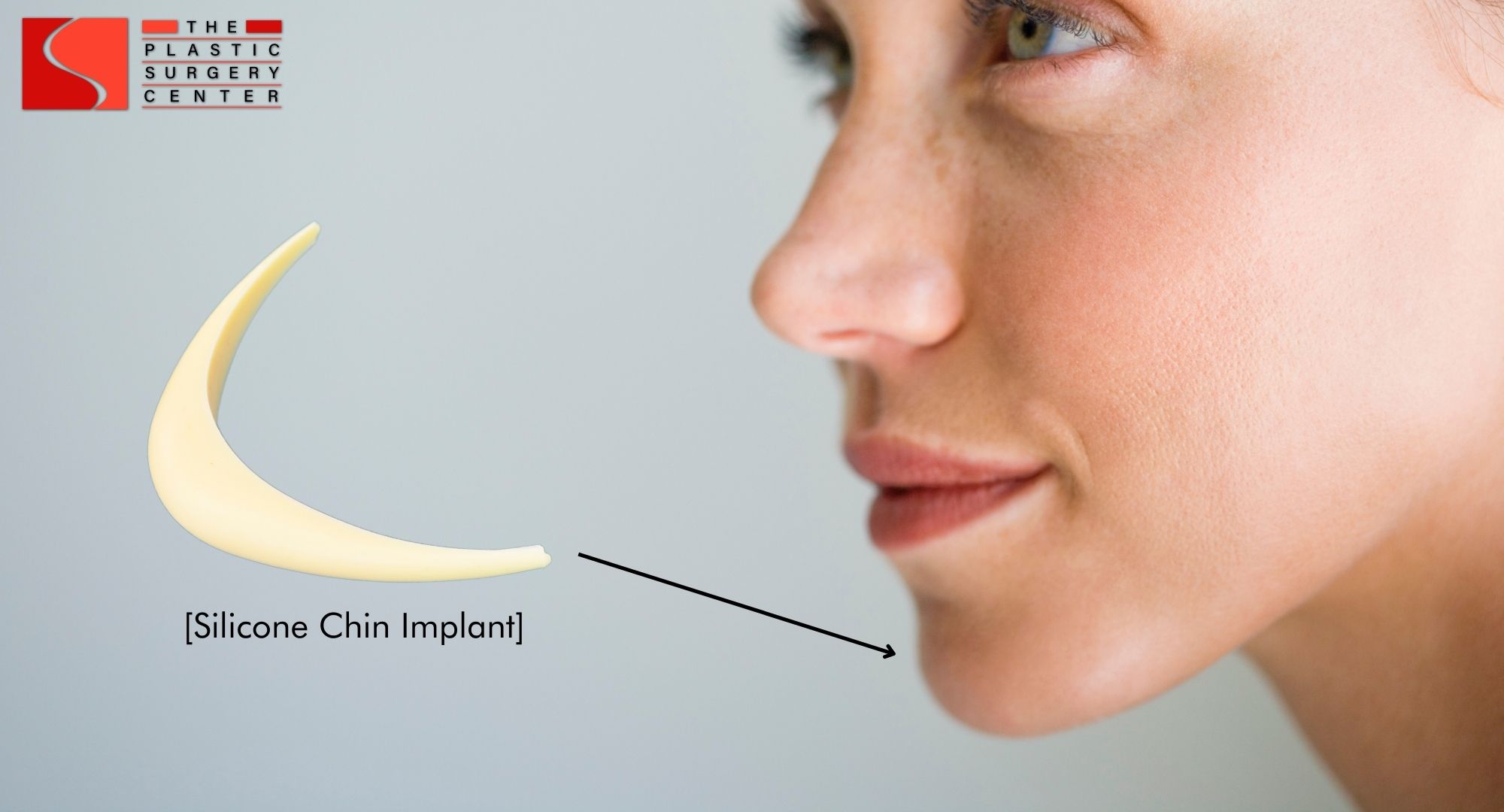 what does a chin implant look like