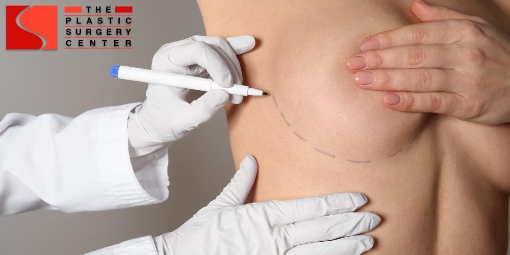 breast augmentation Shreveport