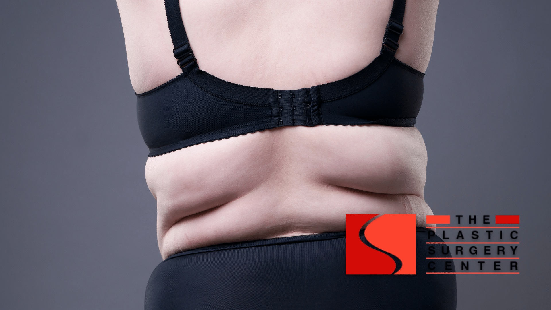 SHREVEPORT Bra Line Back Lift and Back Fat Surgery