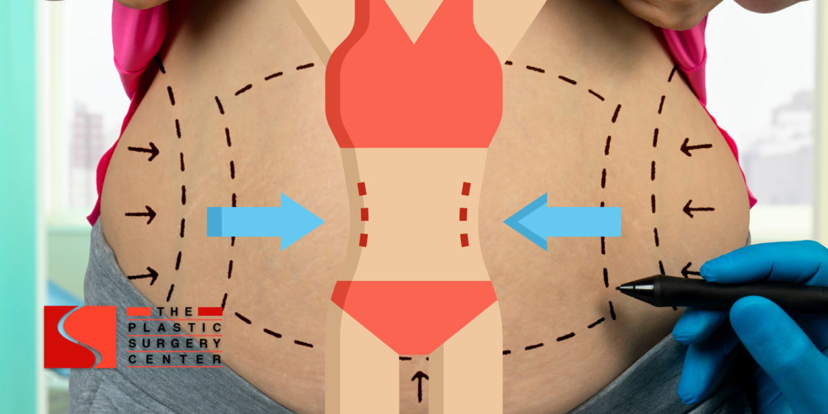 What is a Fleur-de-Lis Tummy Tuck? - Mansfield Cosmetic Surgery Center