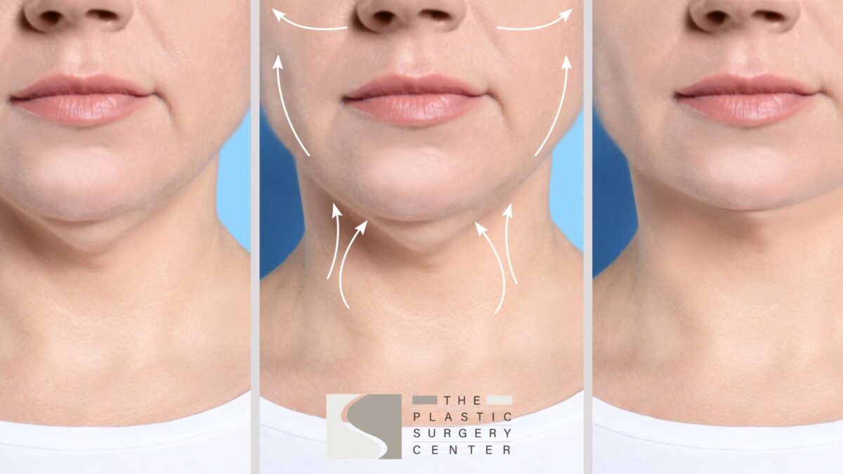 neck and chin liposuction shreveport