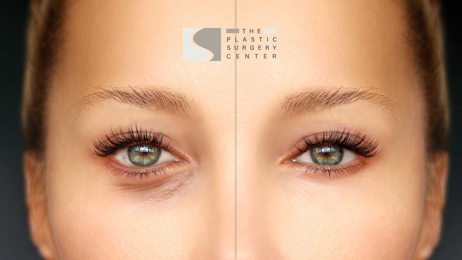 Blepharoplasty Shreveport